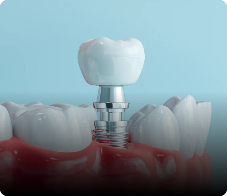 Dental implant illustration with crown